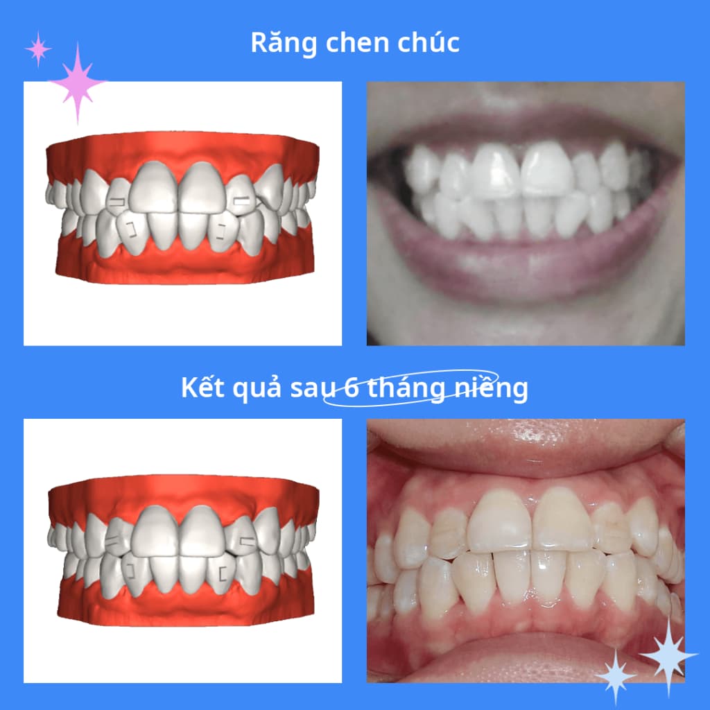 Niềng răng Zenyum có tốt không