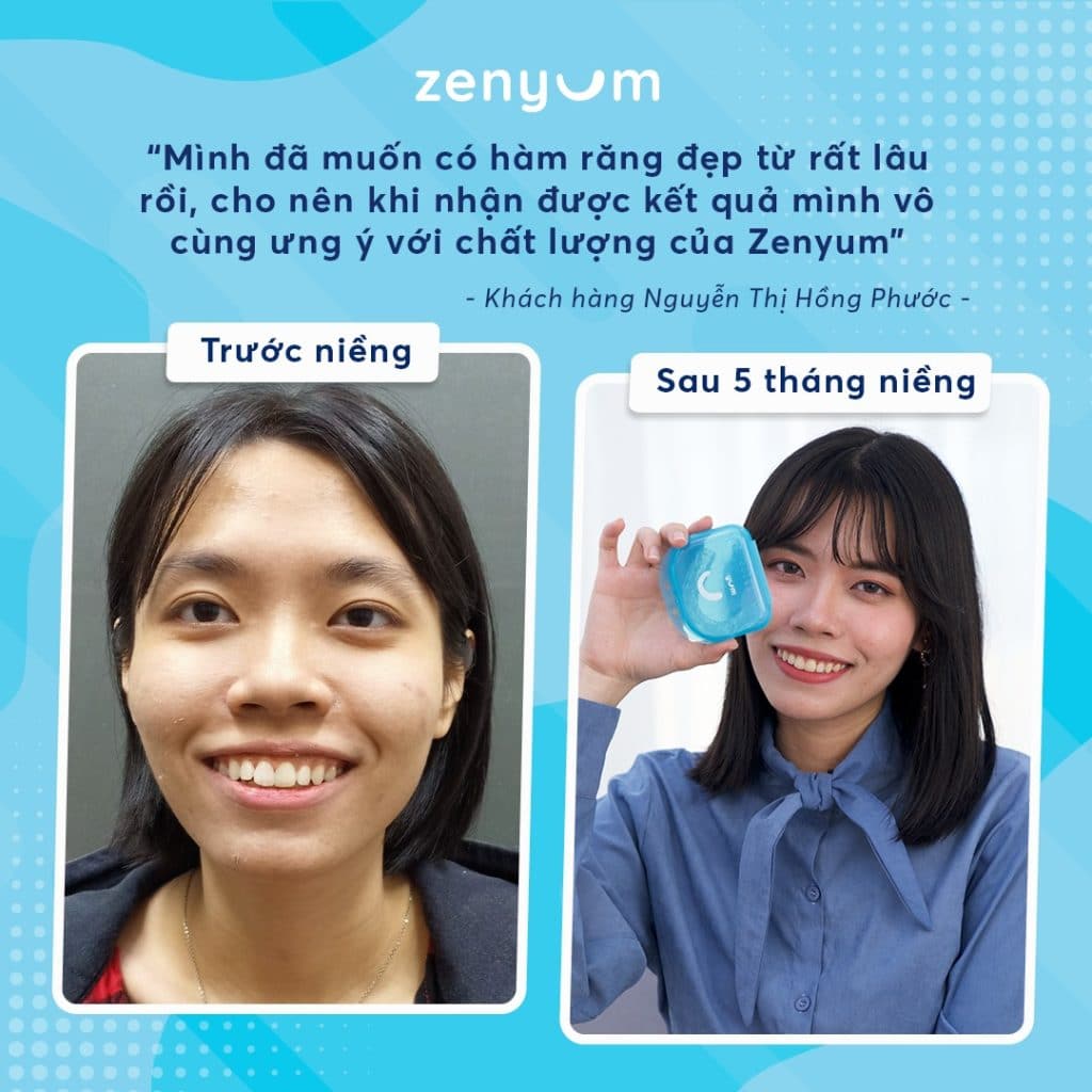kết quả niềng răng hô