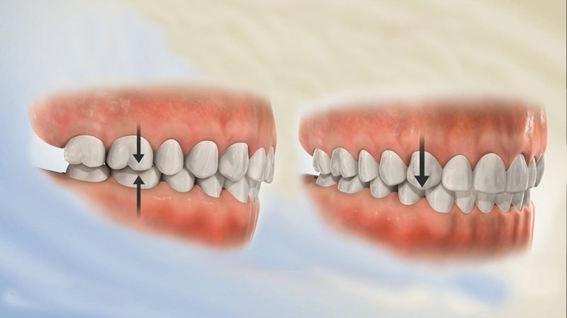 2 ví dụ điển hình về khớp cắn lệch