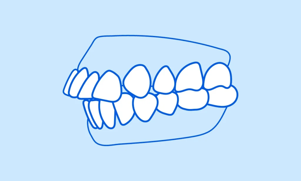 Side view illustration of buck teeth