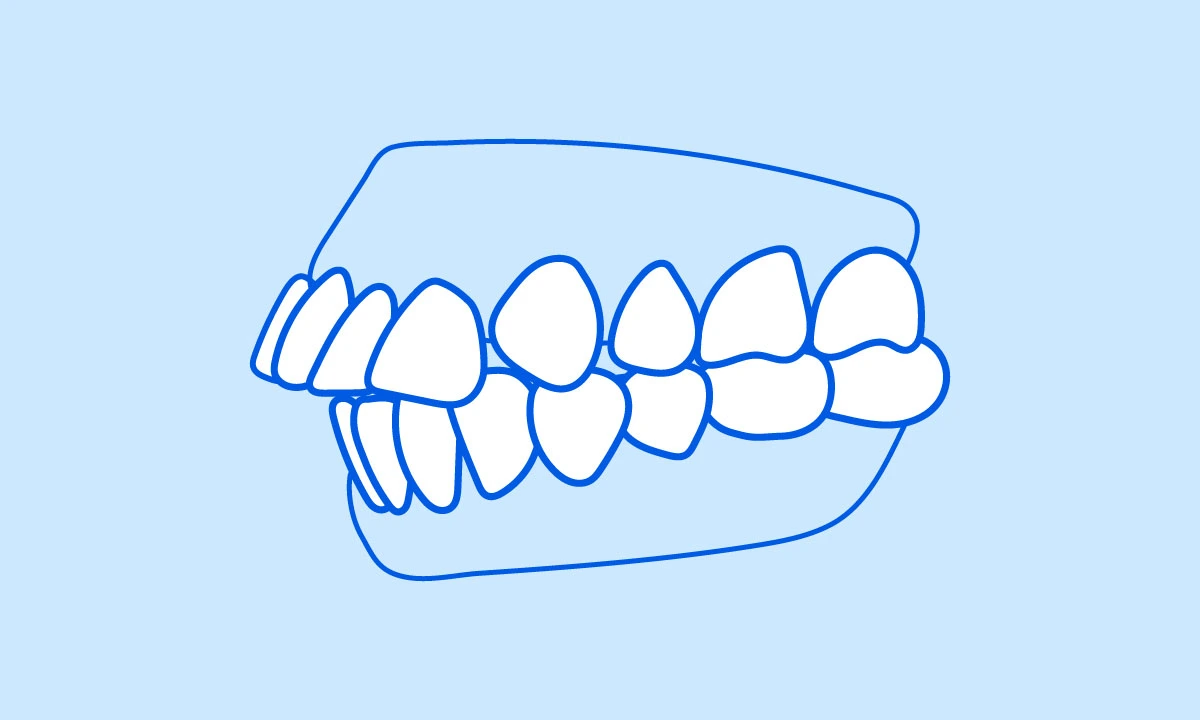 Side view illustration of buck teeth
