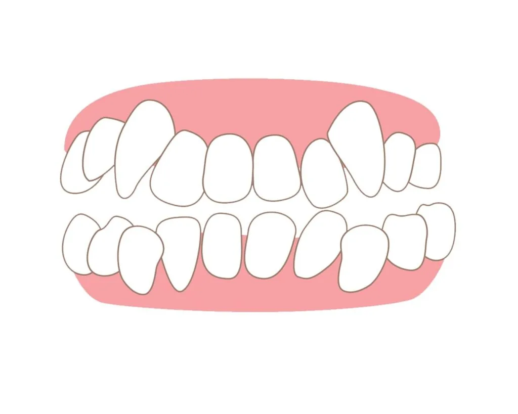 Răng khểnh có nên niềng không?