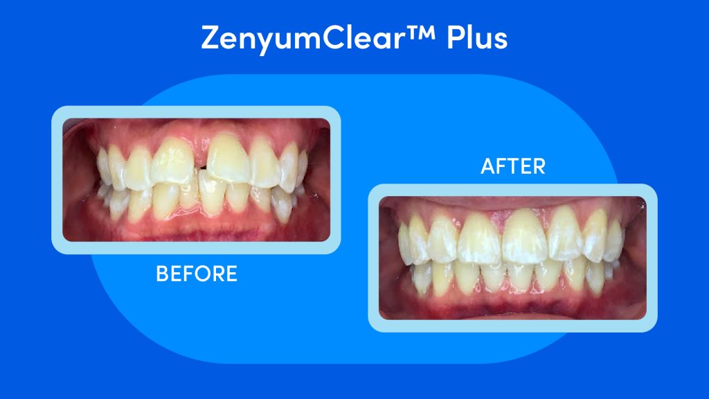 Pic of a before and after ZenyumClear™ case